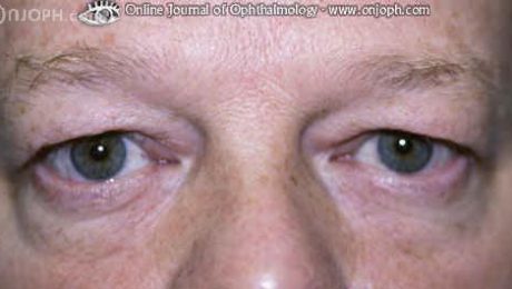 non surgical blepharoplast