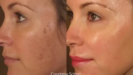 Sciton BBL pigmentation