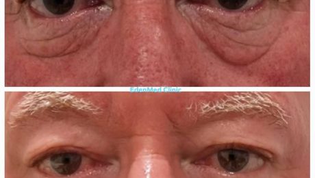 endolift, laser, blepharoplasty, malar bags, eyes. droopy eyelids,