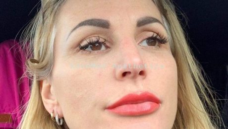 lip dermal filler, dermal filler, poole, bournemouth, dorset