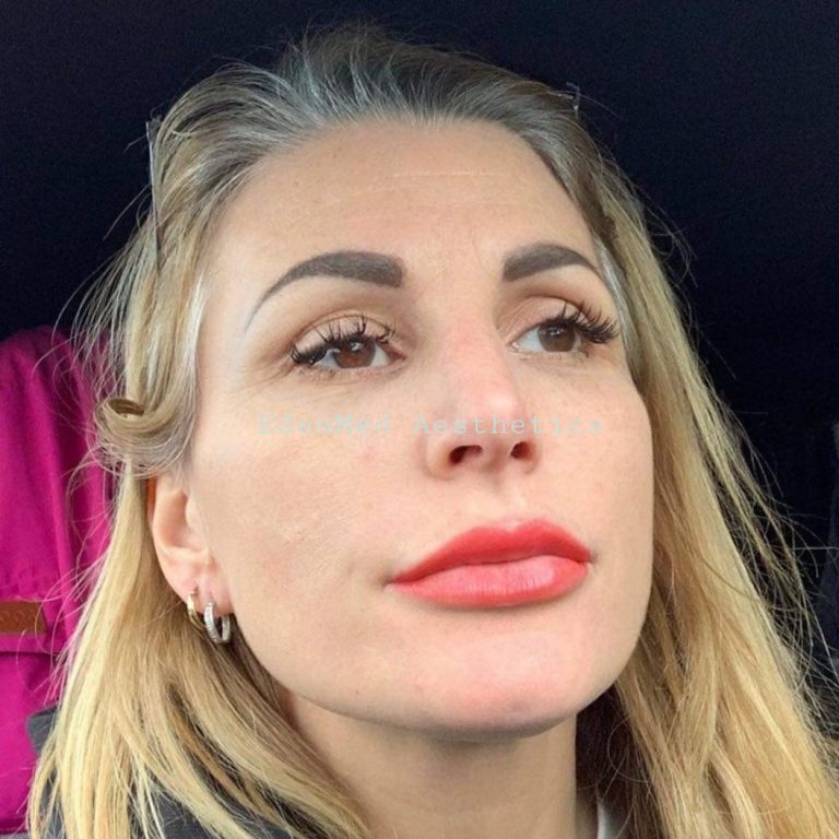 lip dermal filler, dermal filler, poole, bournemouth, dorset