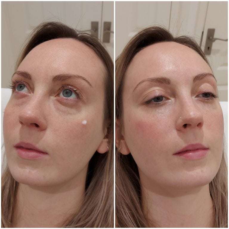 Tear trough dermal filler, bournemouth, BH2, Chelsea, Poole, Dorset, London, expert