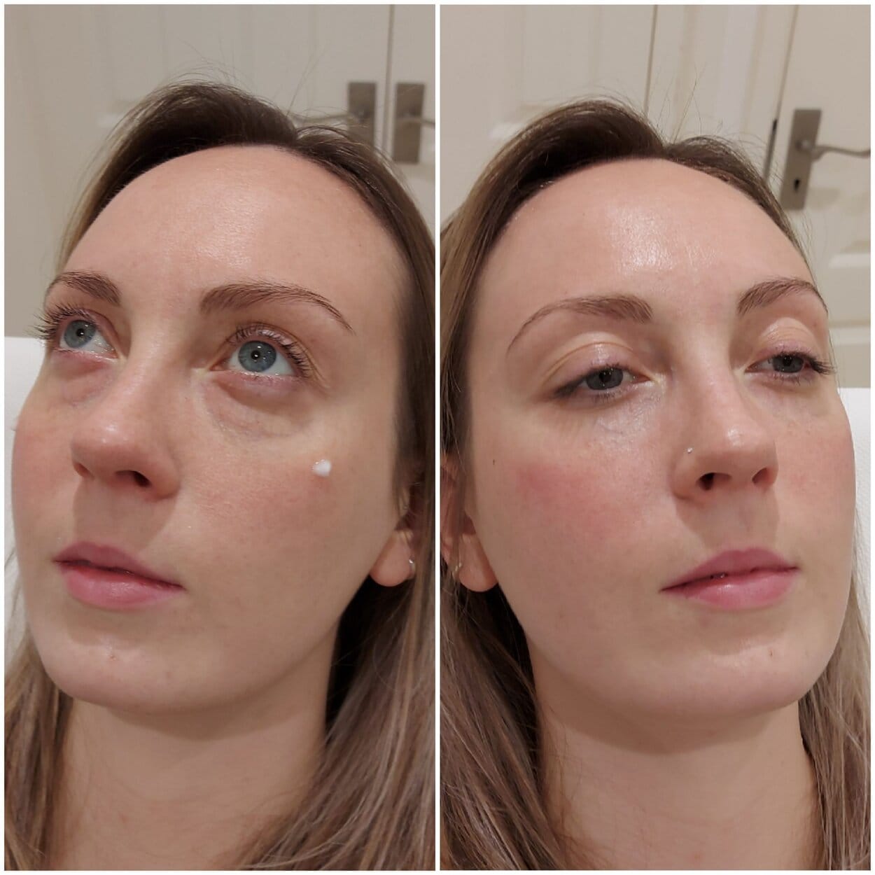 Tear trough dermal filler, bournemouth, BH2, Chelsea, Poole, Dorset, London, expert