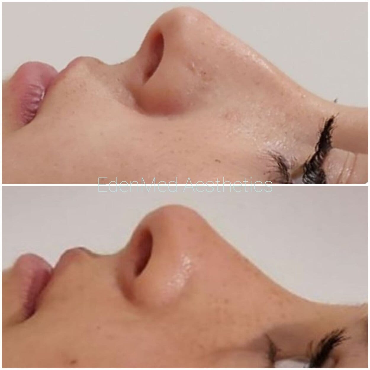liquid rhinoplasty dermal filler, filler rhinoplasty, nose filler, bournemouth, chelsea
