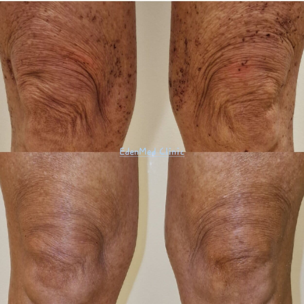 Endolift and BBL Knees, chelsea, bournemouth, expert