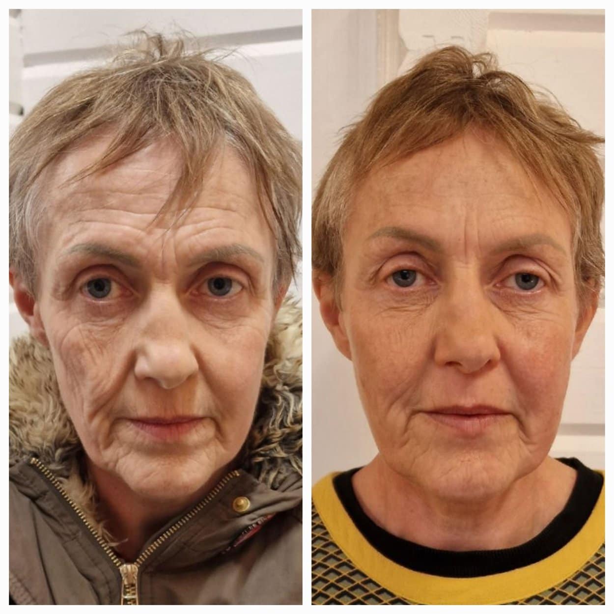 advanced facial dermal filler