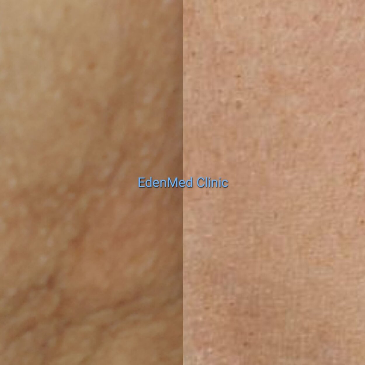 endolift arms, chelsea, bournemouth, before and after