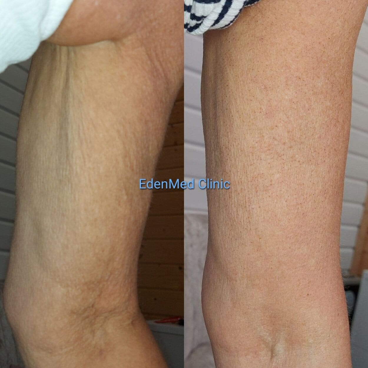 endolift arms, bournemouth, chelsea