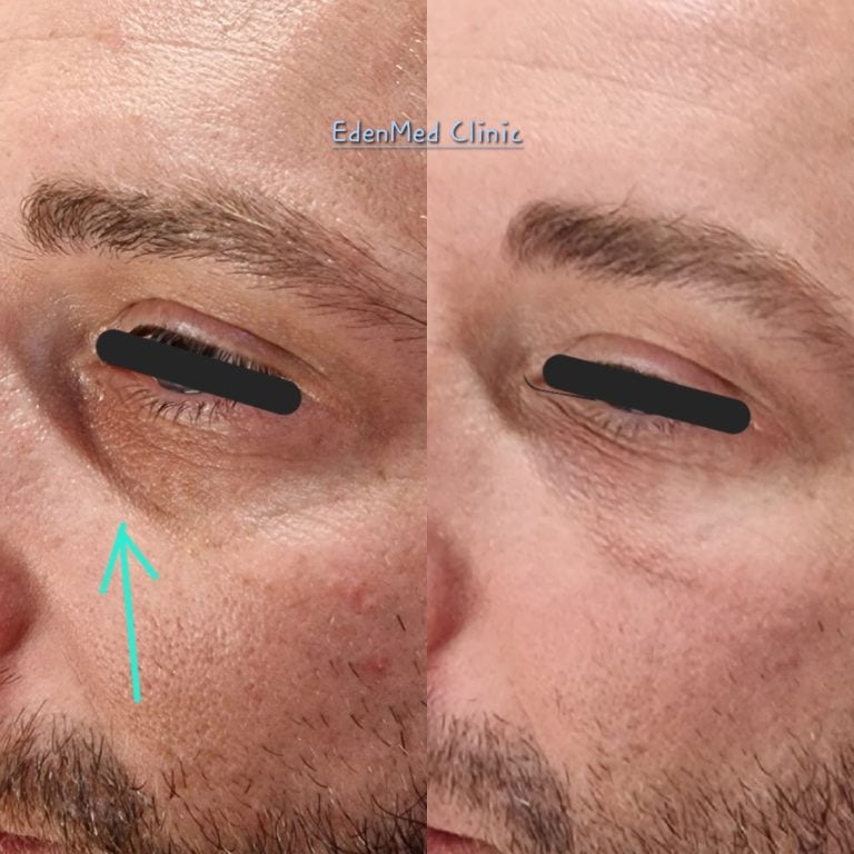 tear trough dermal filler