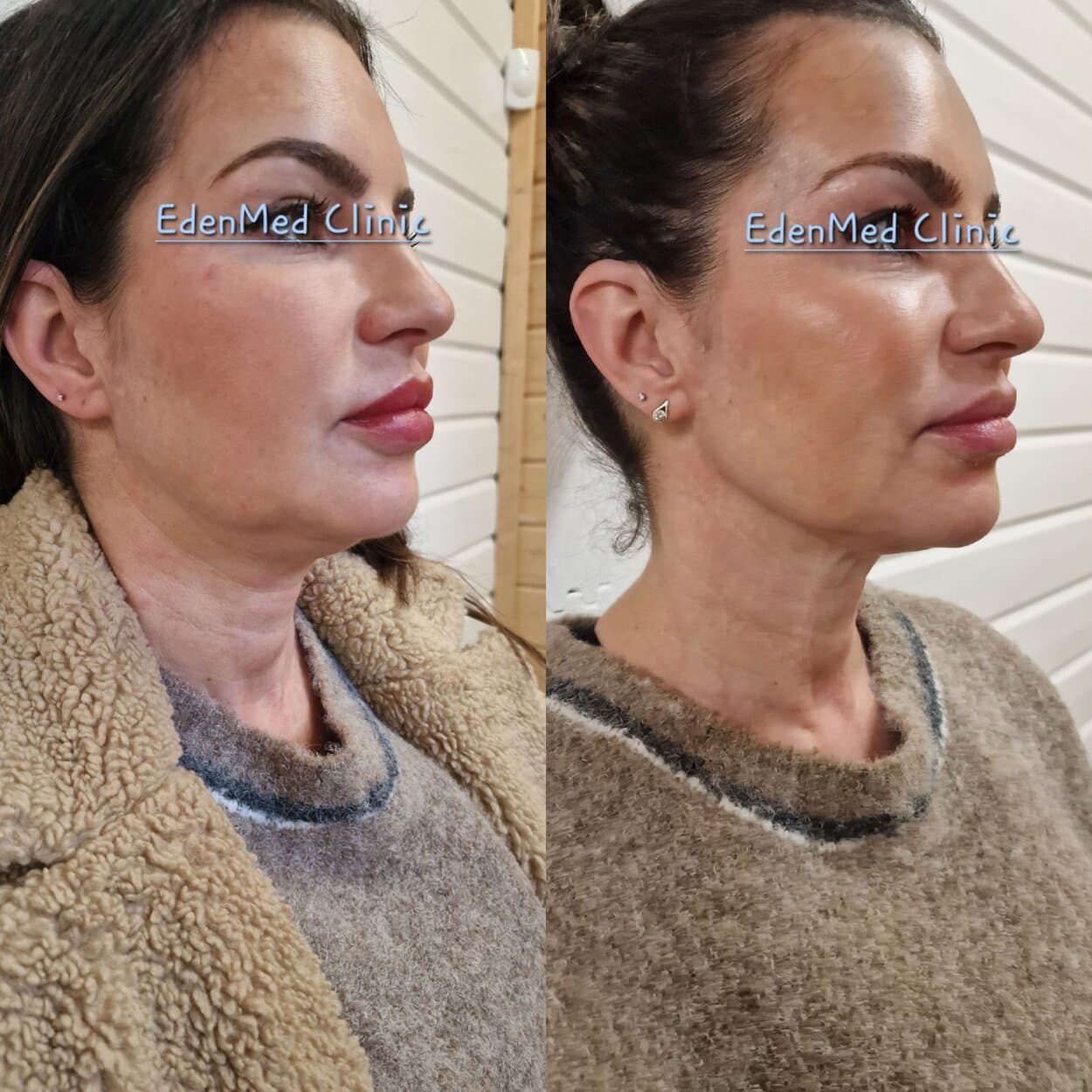Endolift, facelift, neck lift, neck slimming