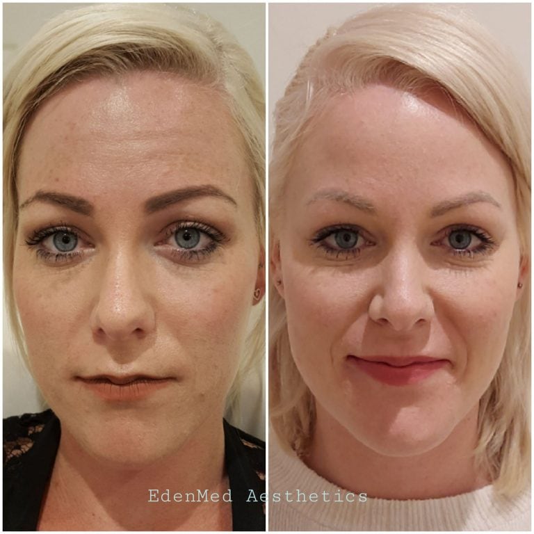 botox, dermal filler, lip filler, EdenMed, bournemouth, chelsea