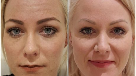 botox, dermal filler, lip filler, EdenMed, bournemouth, chelsea