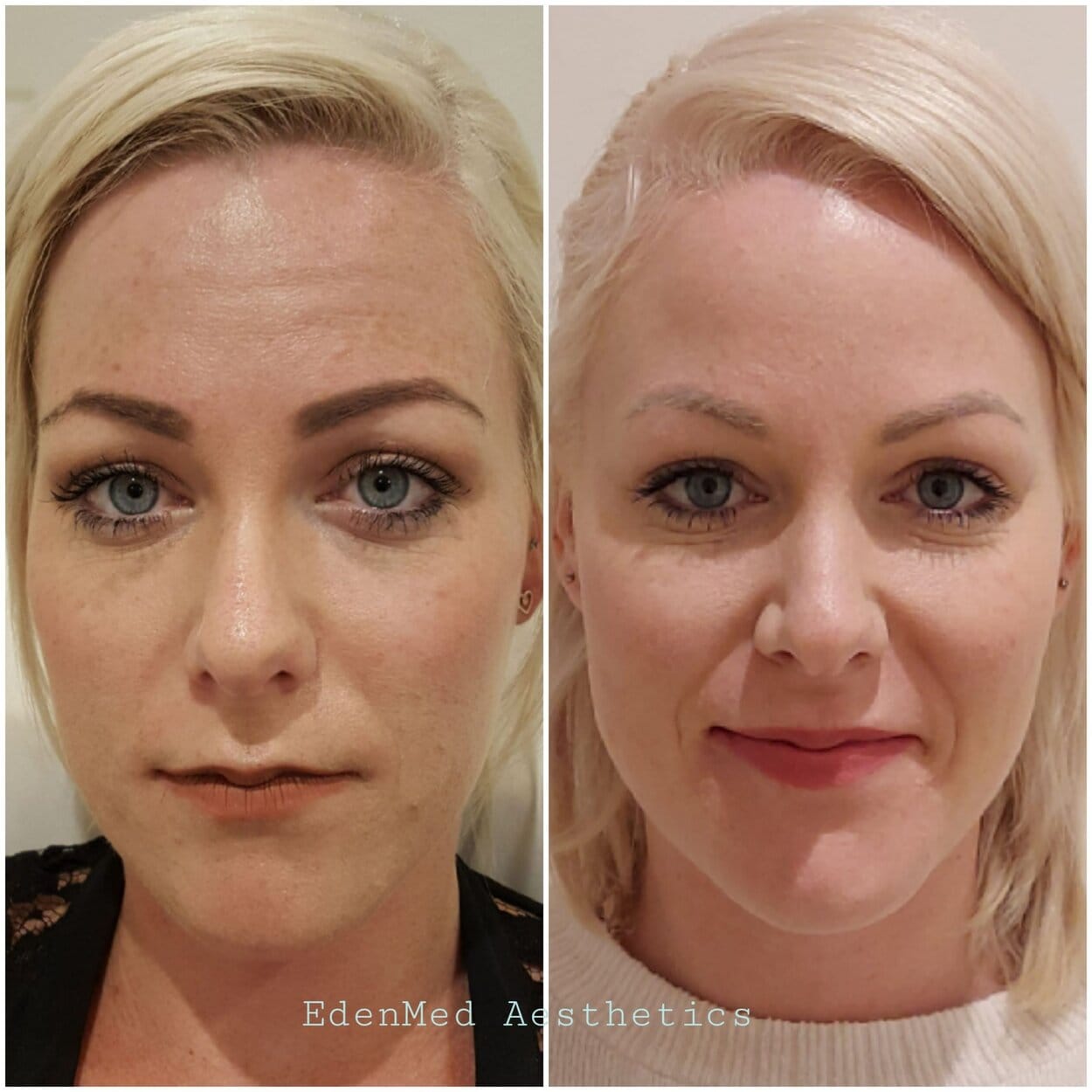 botox, dermal filler, lip filler, EdenMed, bournemouth, chelsea