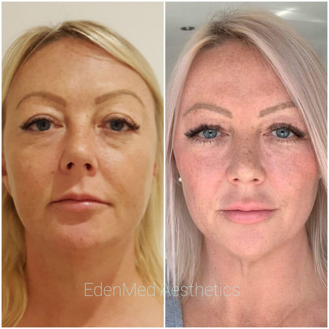 botox, dermal filler, bournemouth, chelsea