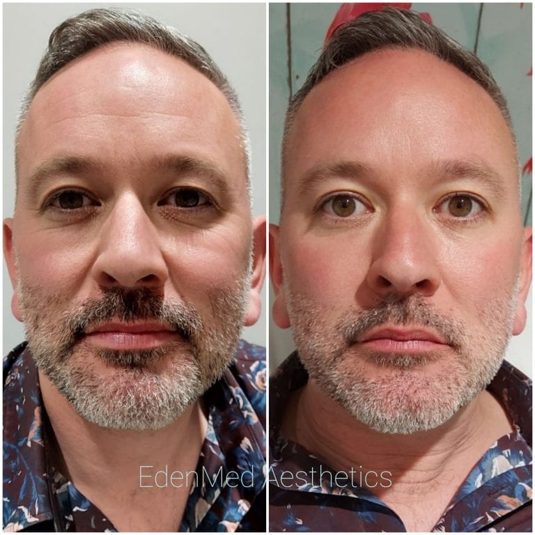 botox, bournemouth, chelsea