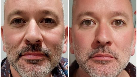 botox, bournemouth, chelsea