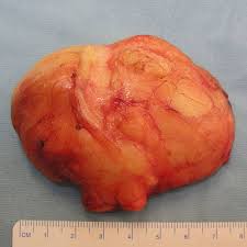 lipoma