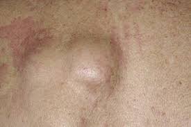 lipoma